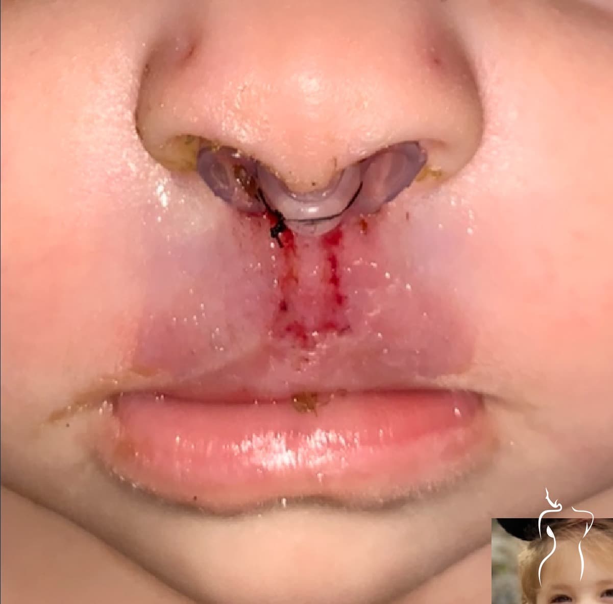 Cleft Lip Repair, 1 week — actual patient of Dr. Day