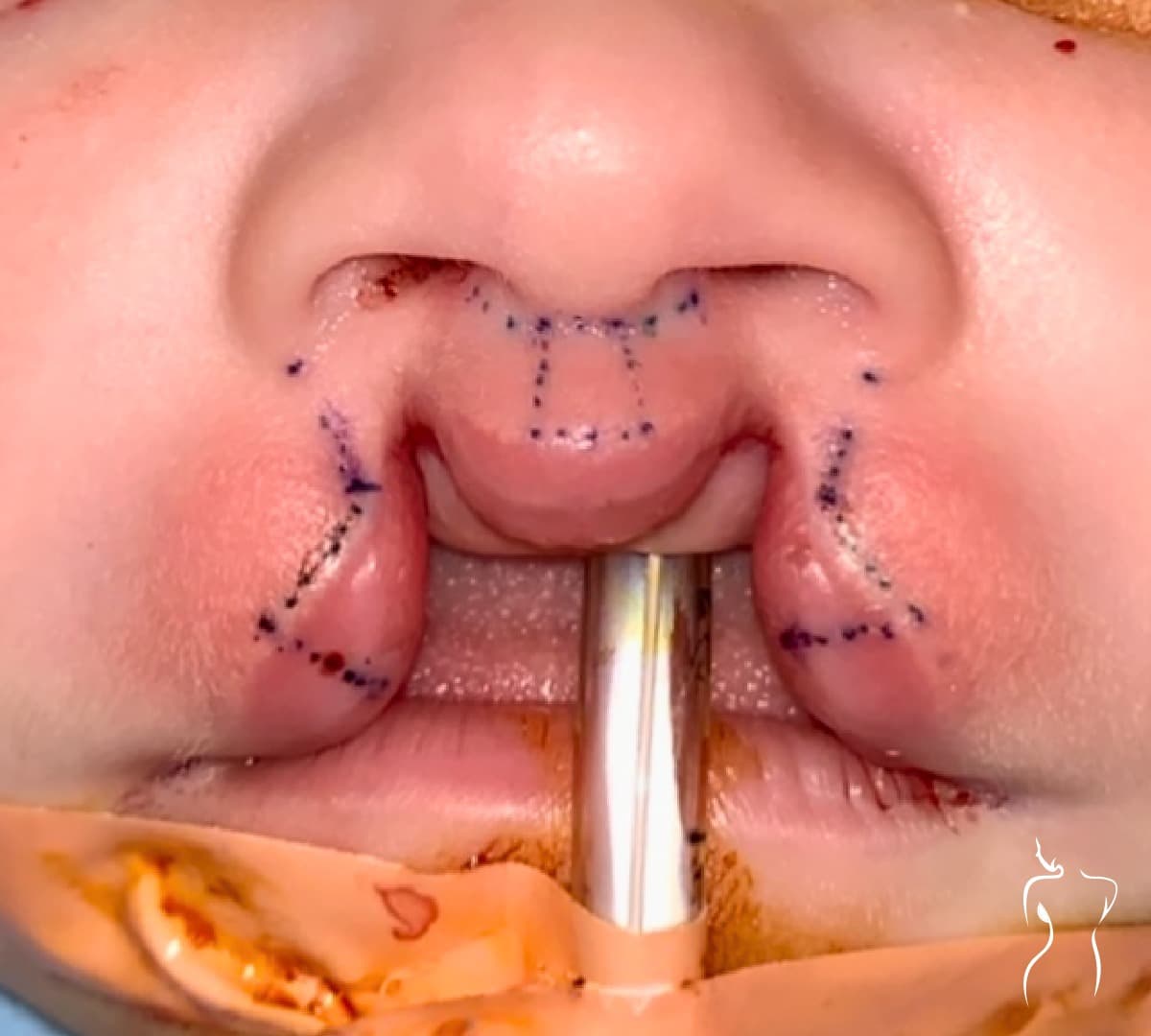 Cleft Lip Repair, before — actual patient of Dr. Day