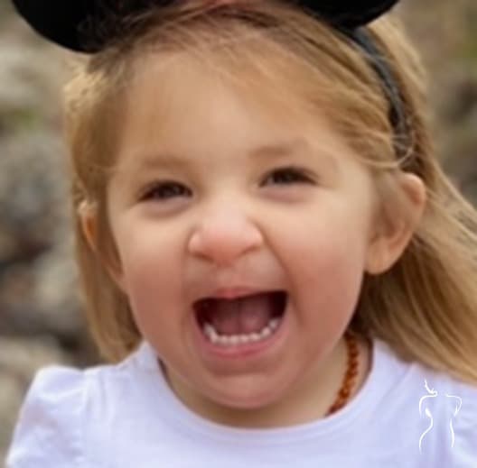Cleft Lip Repair, follow-up — actual patient of Dr. Day