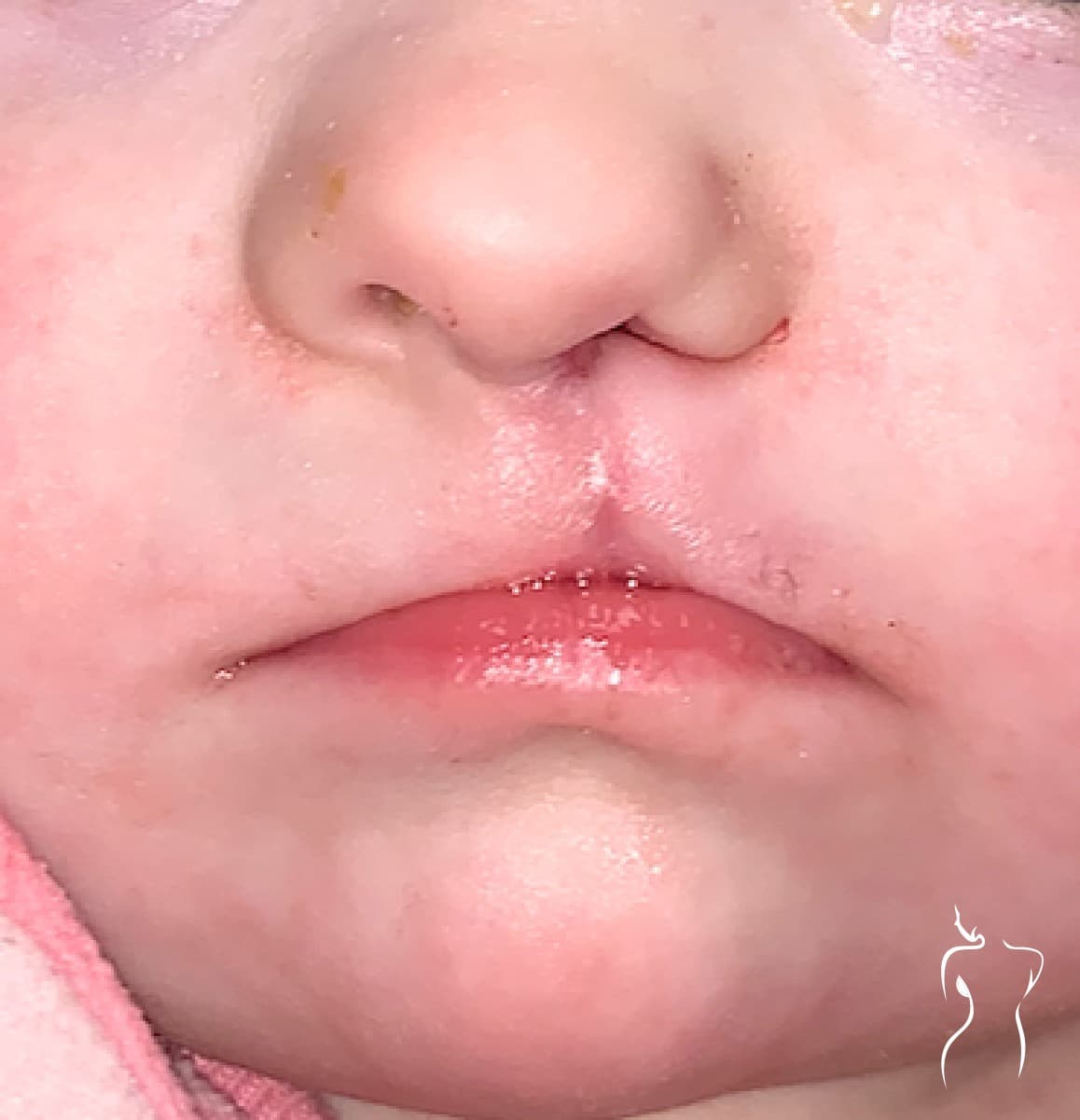 Cleft Lip Repair, after — actual patient of Dr. Day