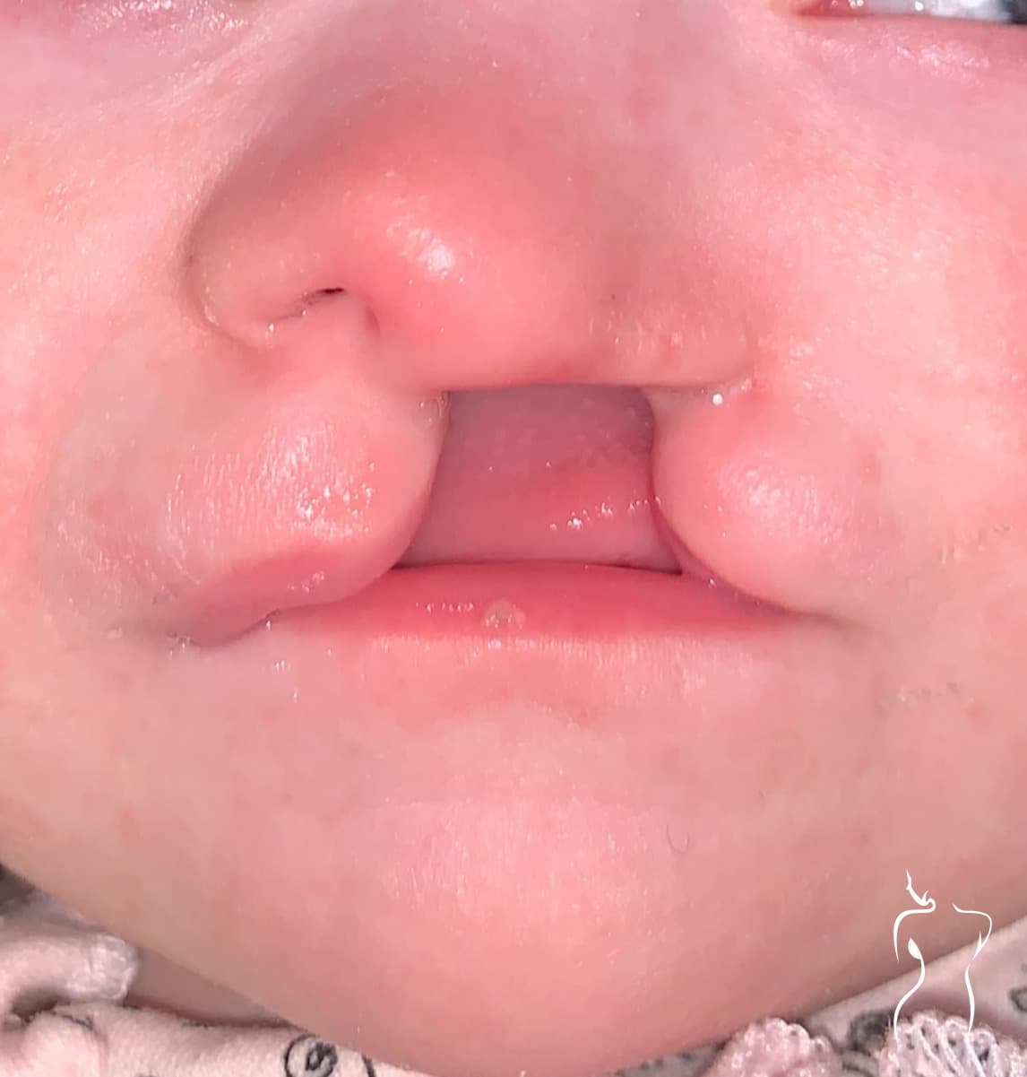 Cleft Lip Repair, before — actual patient of Dr. Day