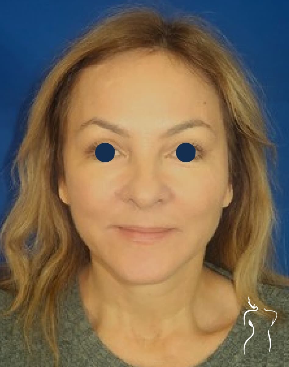 Face & Neck Lift, after — actual patient of Dr. Day