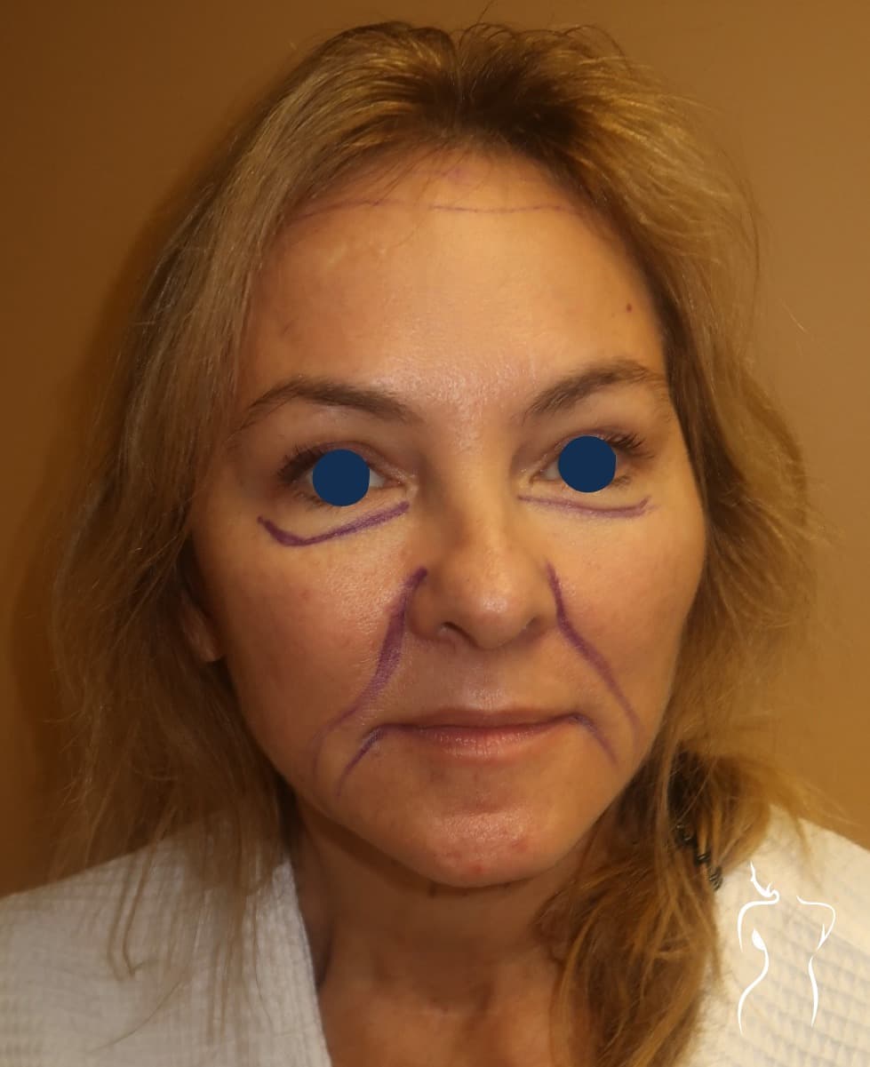 Face & Neck Lift, before — actual patient of Dr. Day