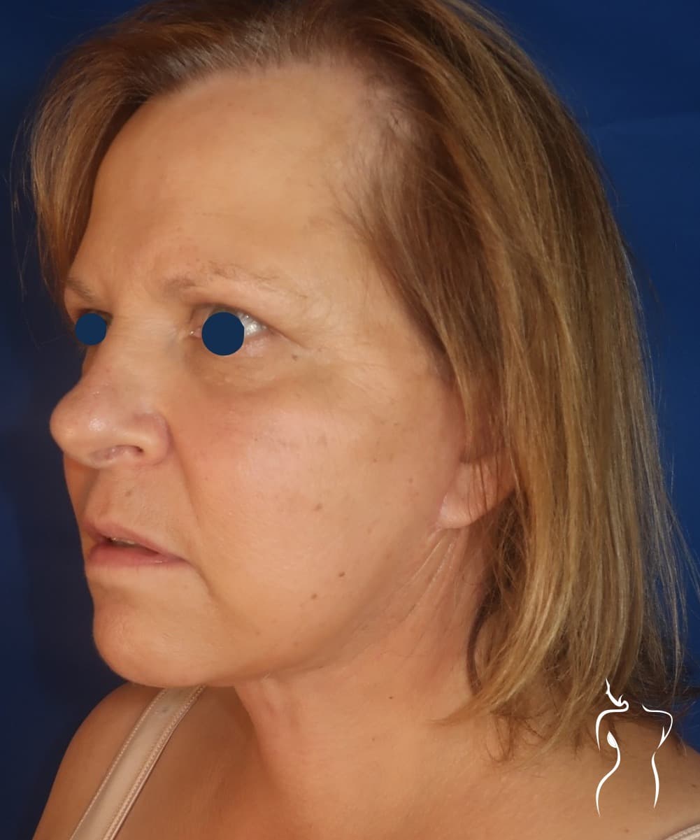 Face & Neck Lift, after — actual patient of Dr. Day