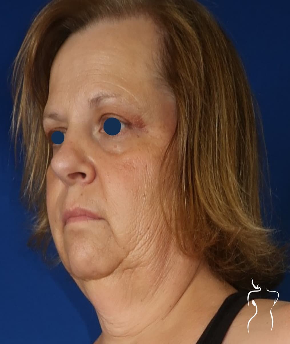 Face & Neck Lift, before — actual patient of Dr. Day