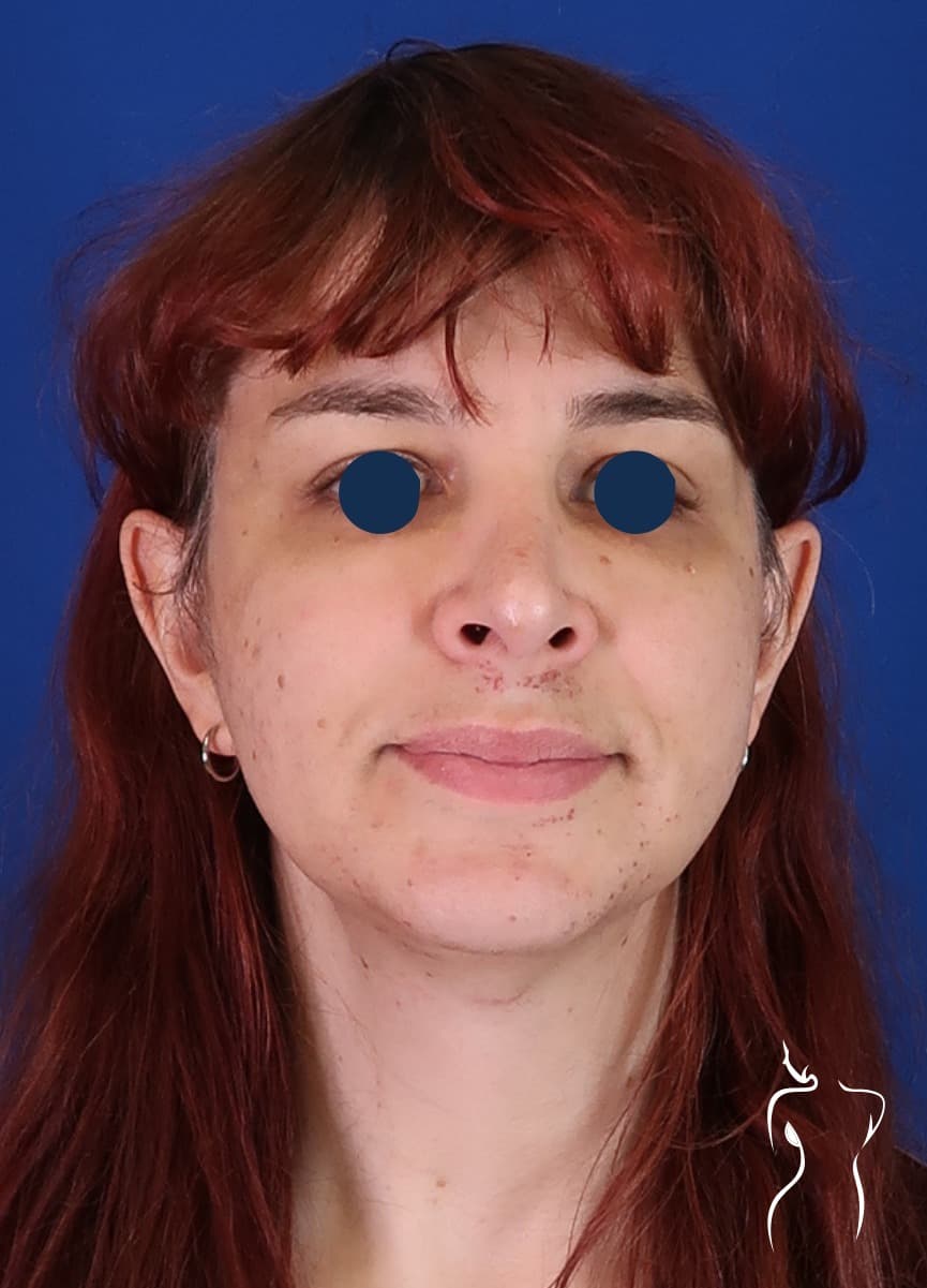 Facial Feminization, after — actual patient of Dr. Day