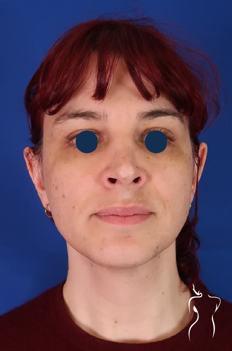 Facial Feminization, before — actual patient of Dr. Day