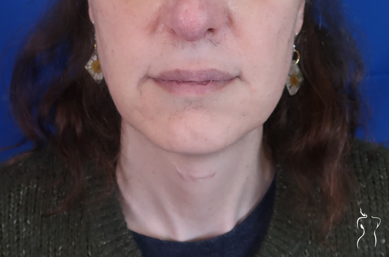 Facial Feminization, after — actual patient of Dr. Day
