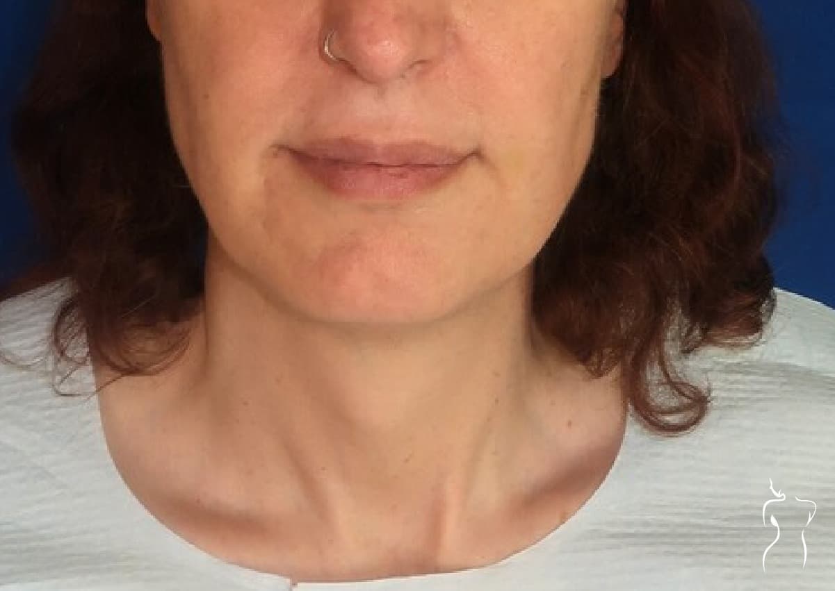 Facial Feminization, before — actual patient of Dr. Day