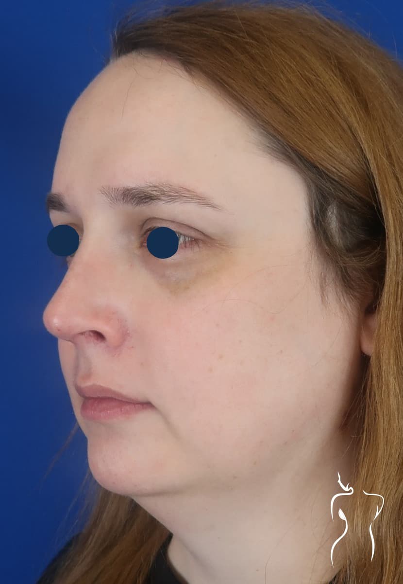 Facial Feminization, after — actual patient of Dr. Day