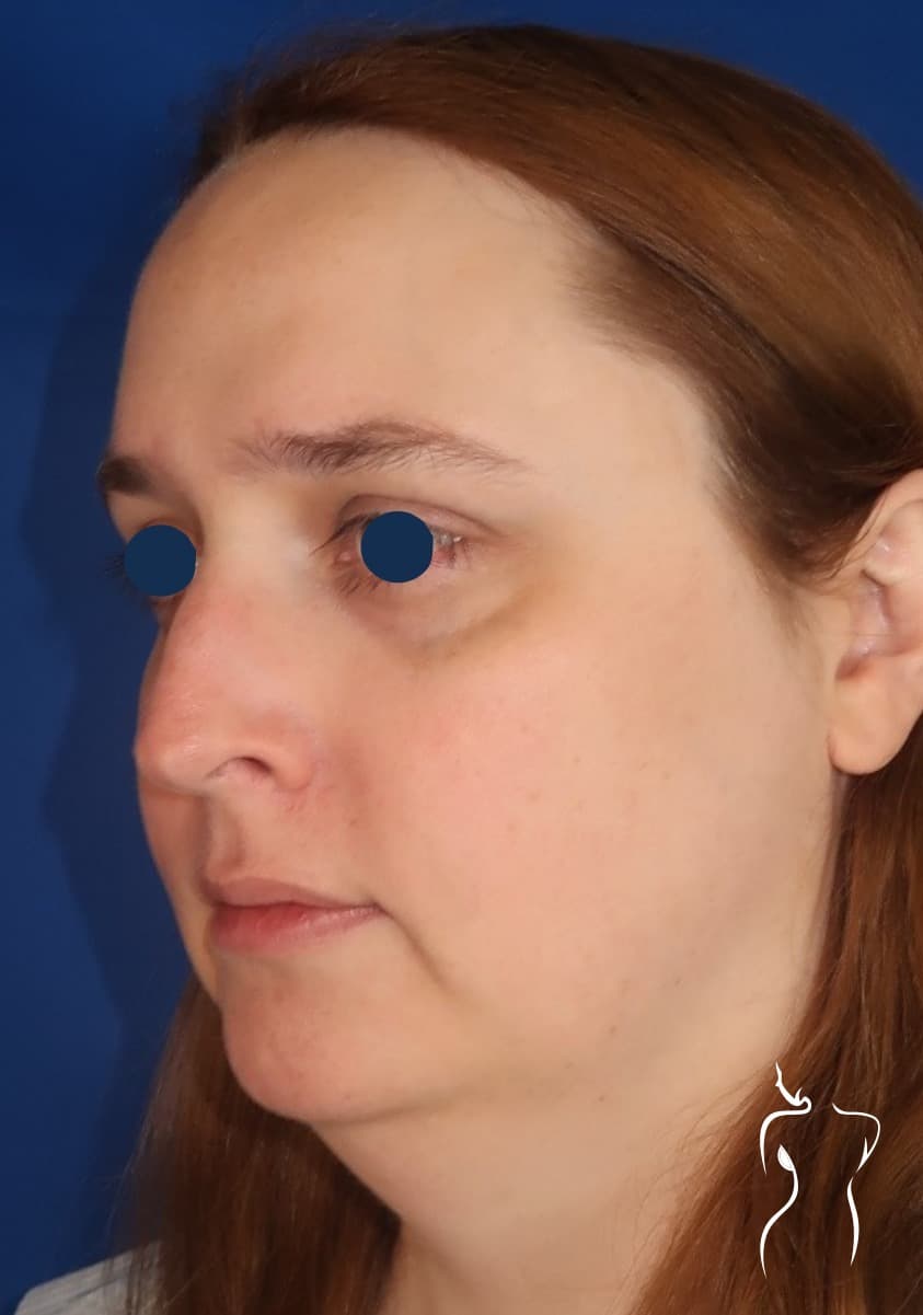 Facial Feminization, before — actual patient of Dr. Day