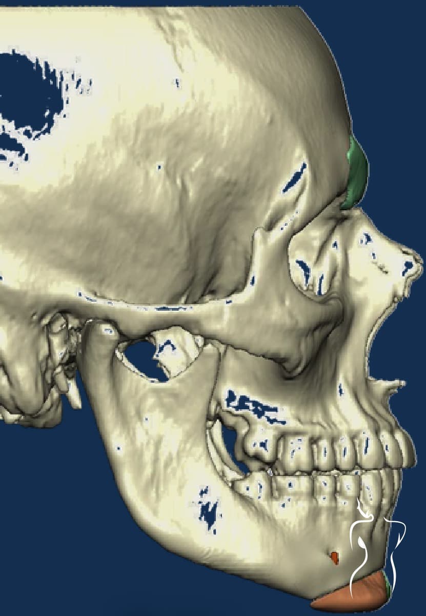 Facial Feminization, after — actual patient of Dr. Day