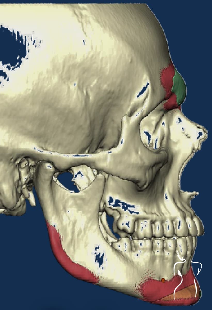 Facial Feminization, before — actual patient of Dr. Day