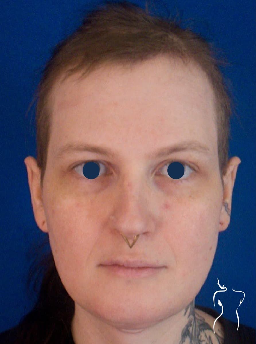 Facial Feminization, after — actual patient of Dr. Day