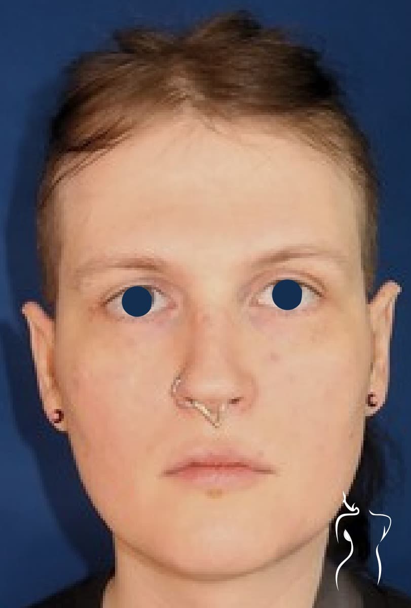 Facial Feminization, before — actual patient of Dr. Day