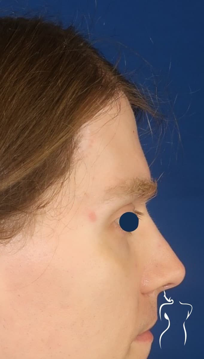 Facial Feminization, after — actual patient of Dr. Day