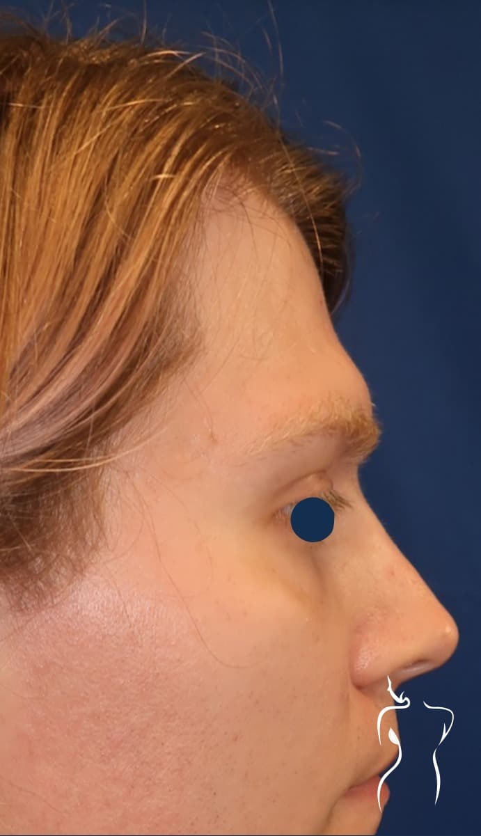 Facial Feminization, before — actual patient of Dr. Day