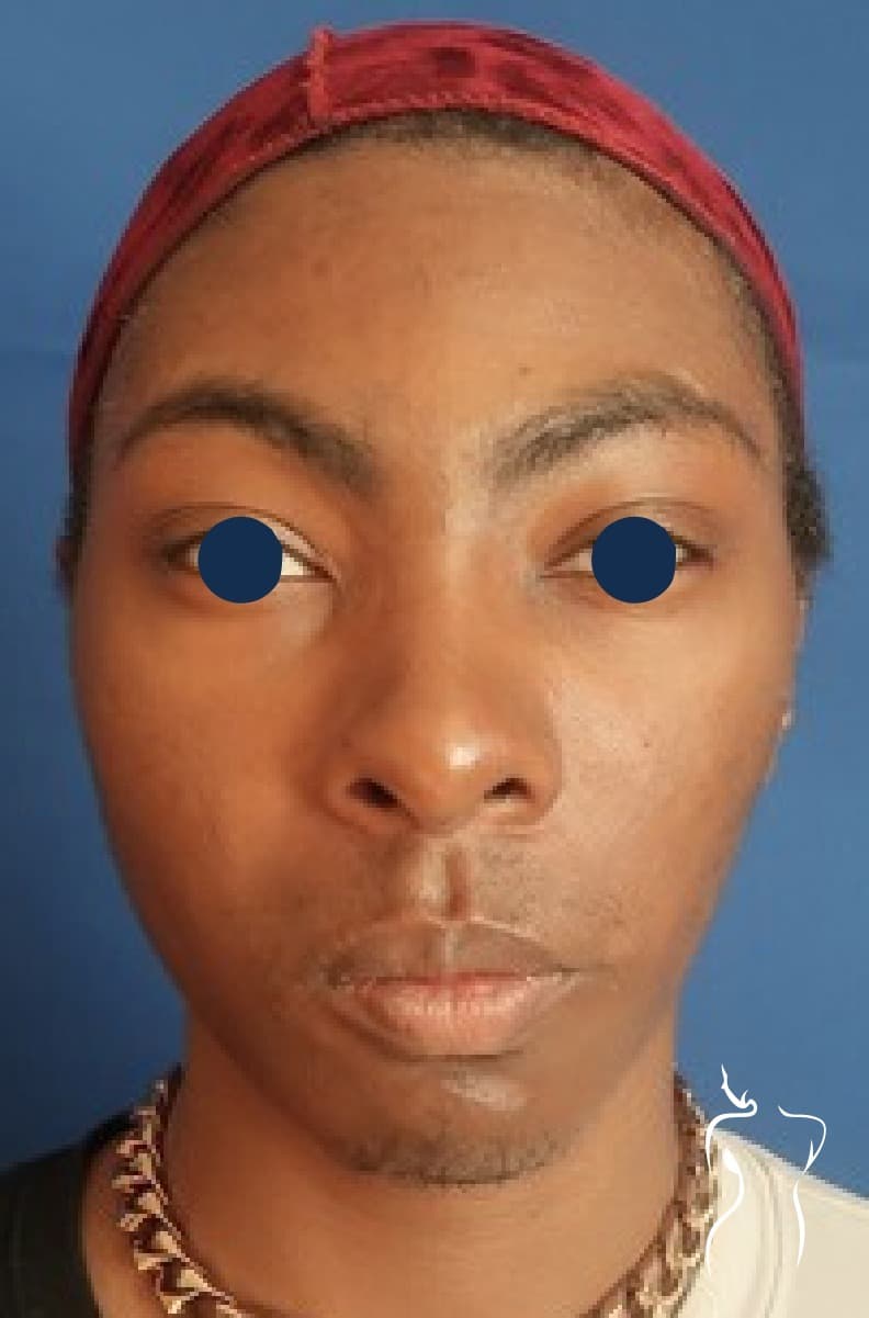 Facial Feminization, after — actual patient of Dr. Day