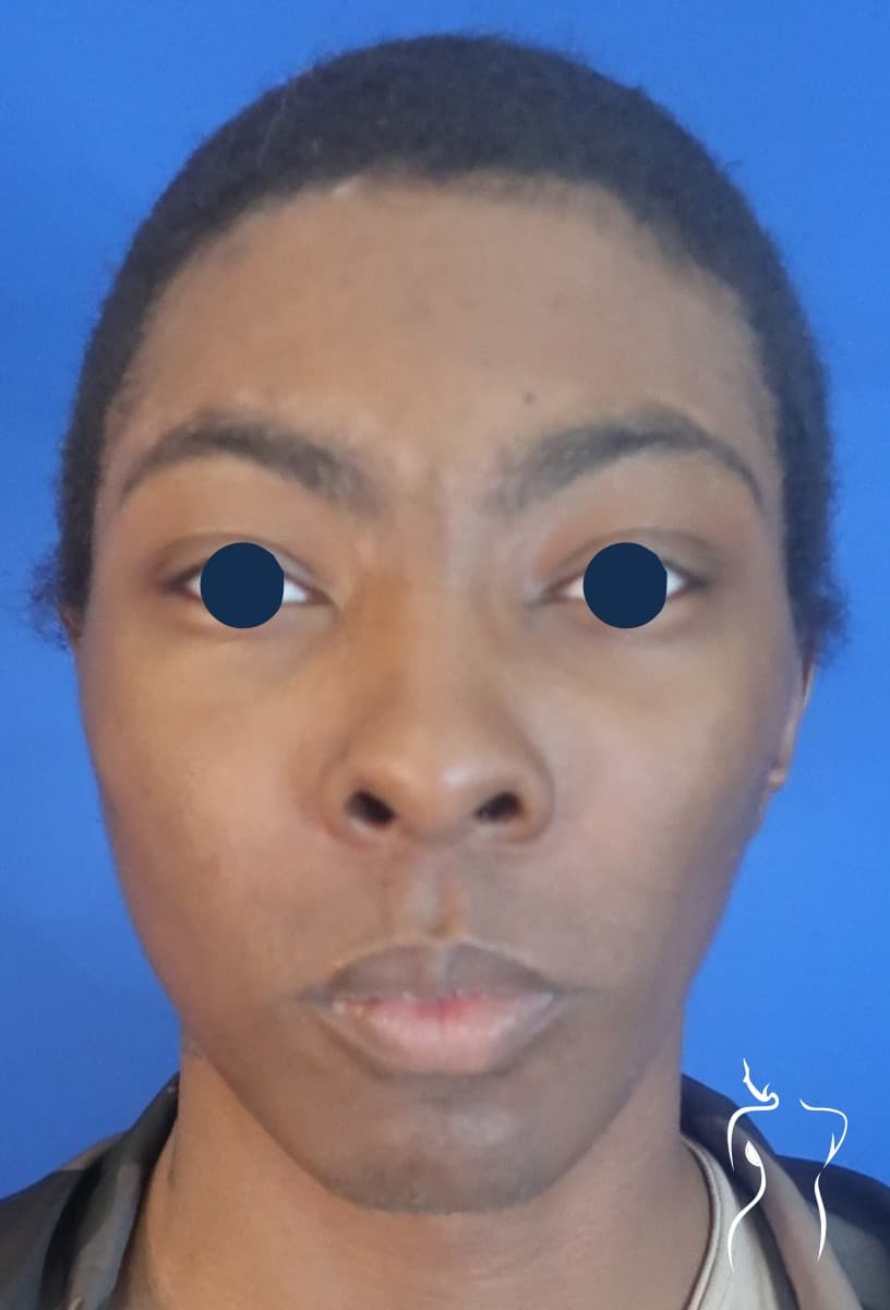 Facial Feminization, before — actual patient of Dr. Day