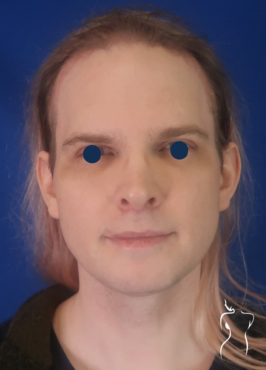 Facial Feminization, after — actual patient of Dr. Day