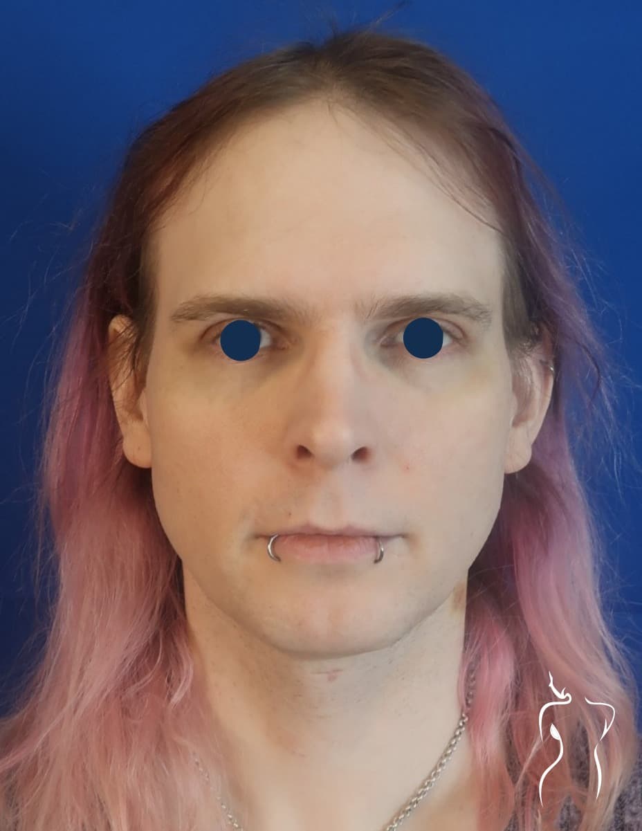Facial Feminization, before — actual patient of Dr. Day