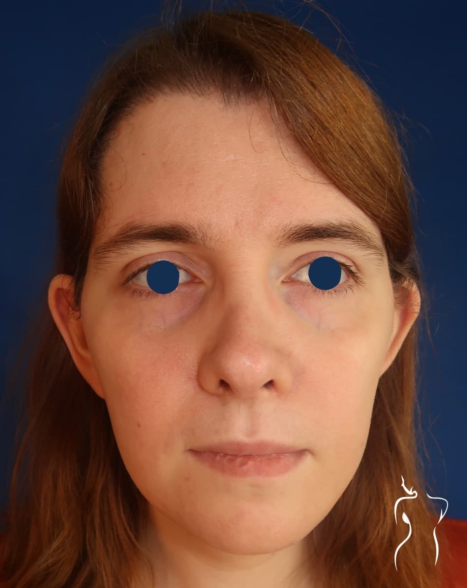 Facial Feminization, after — actual patient of Dr. Day