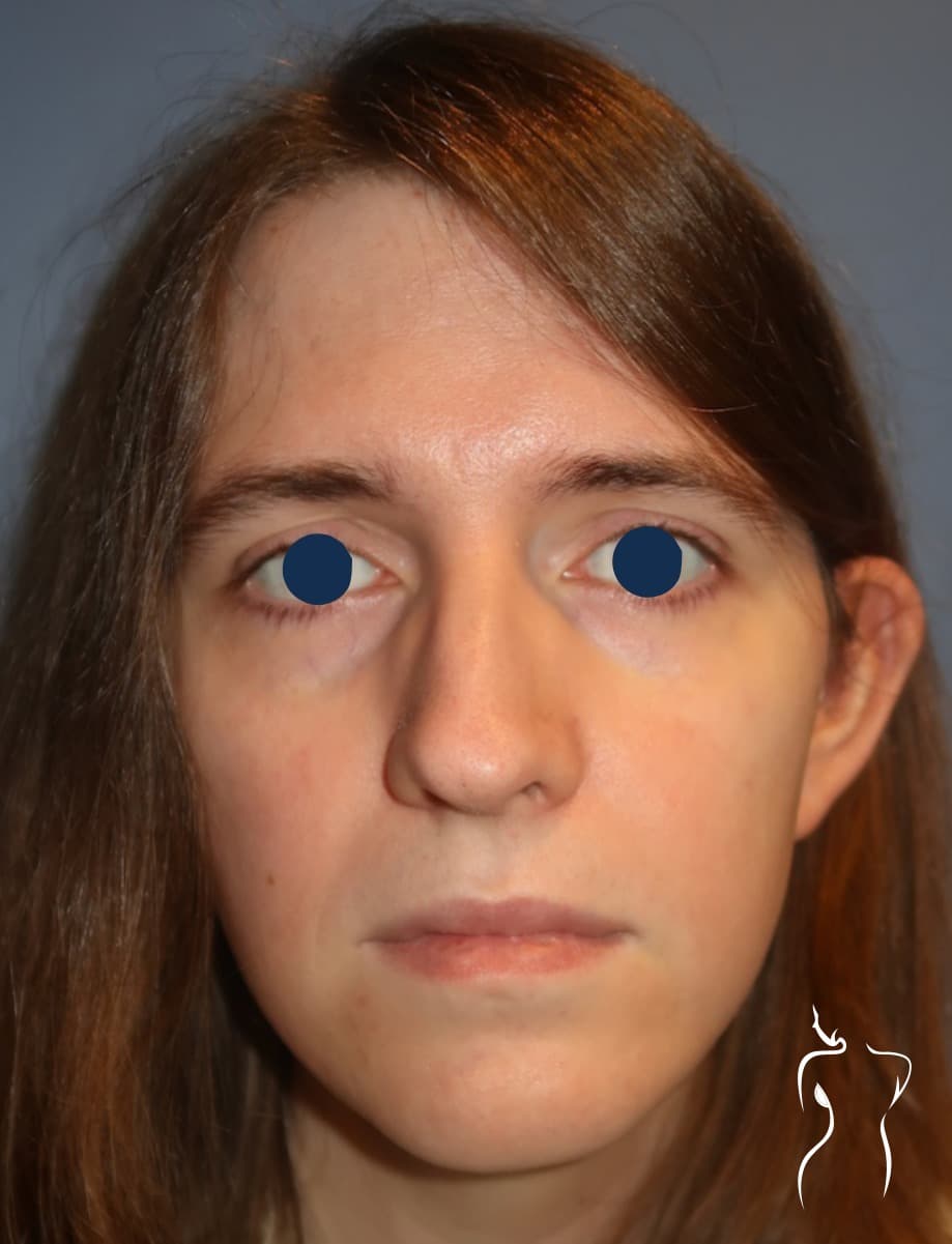 Facial Feminization, before — actual patient of Dr. Day