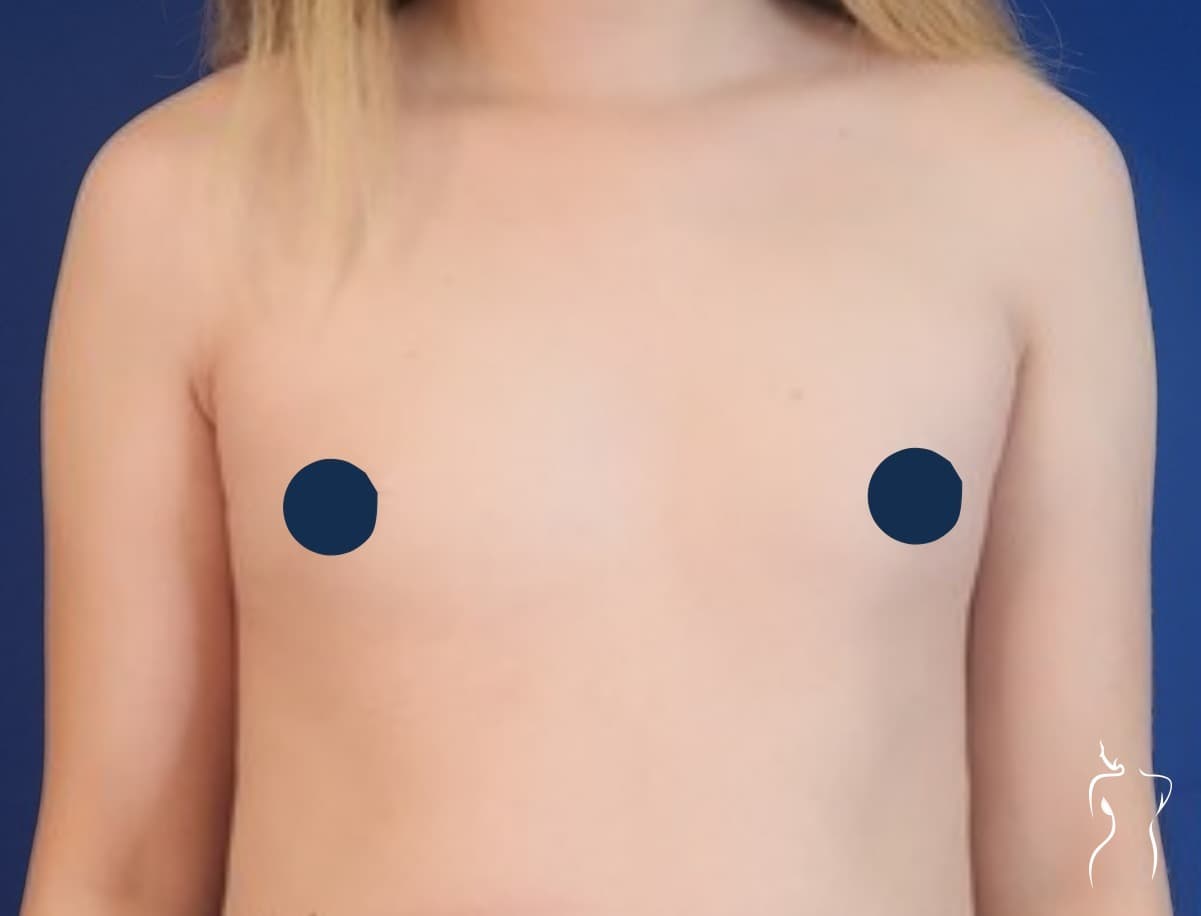 Gender-Affirming Breast Augmentation, before — actual patient of Dr. Day