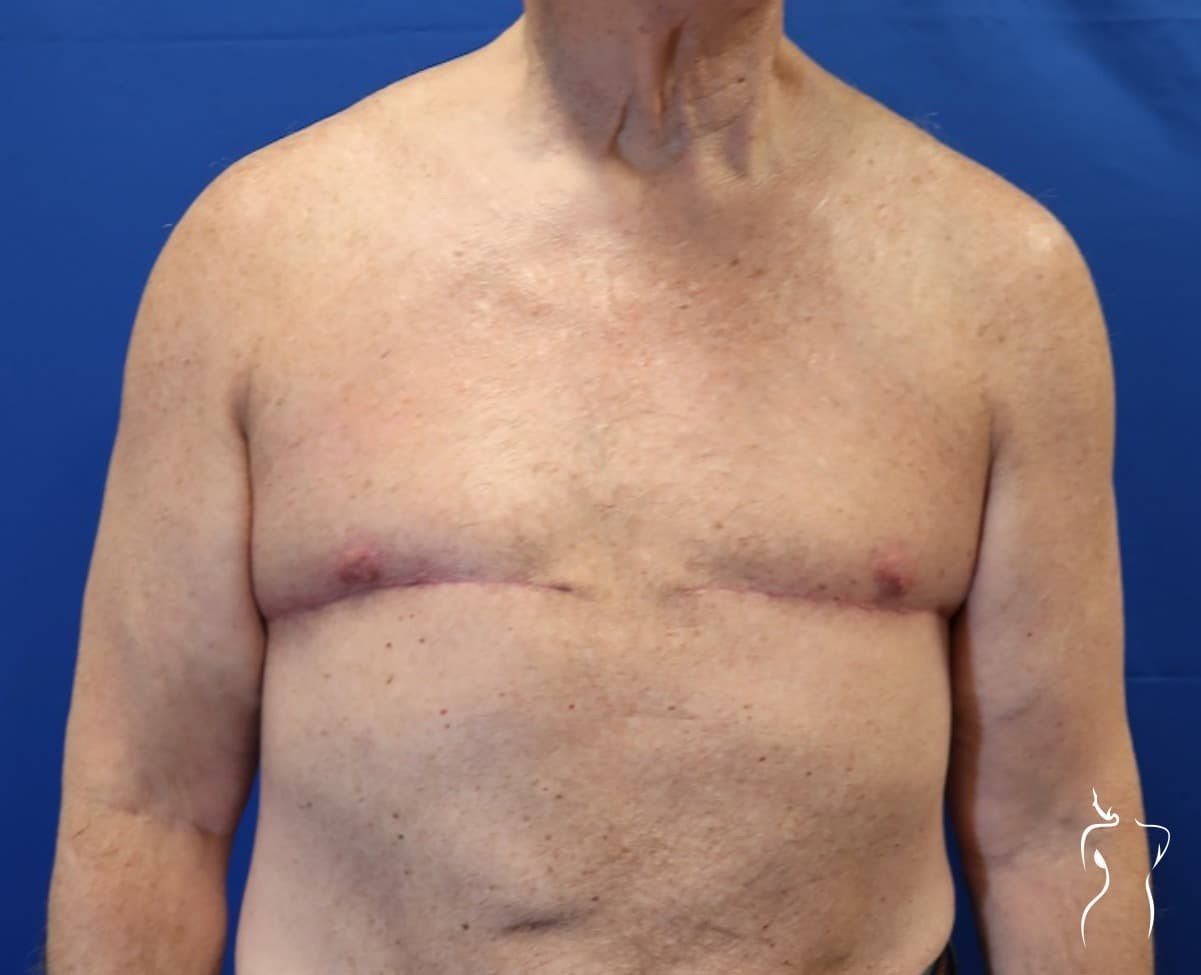 Gynecomastia, after — actual patient of Dr. Day