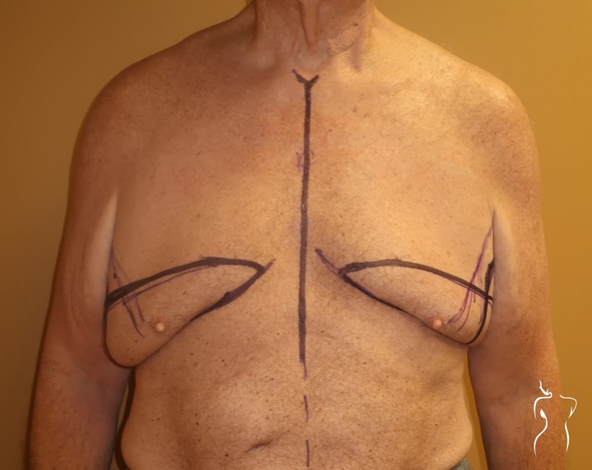 Gynecomastia, before — actual patient of Dr. Day