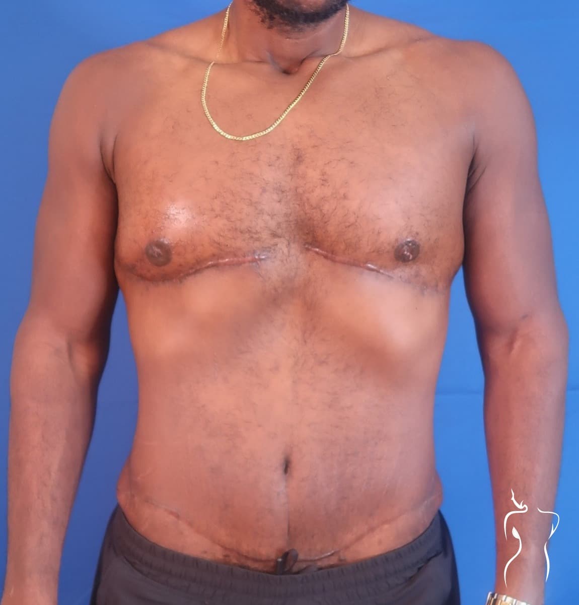 Gynecomastia, after — actual patient of Dr. Day