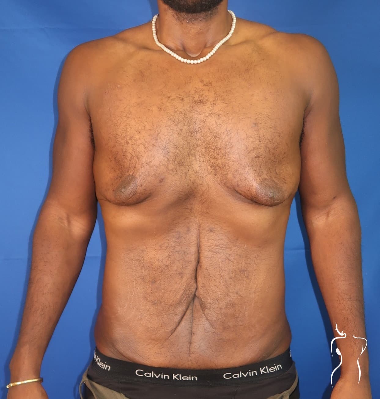 Gynecomastia, before — actual patient of Dr. Day
