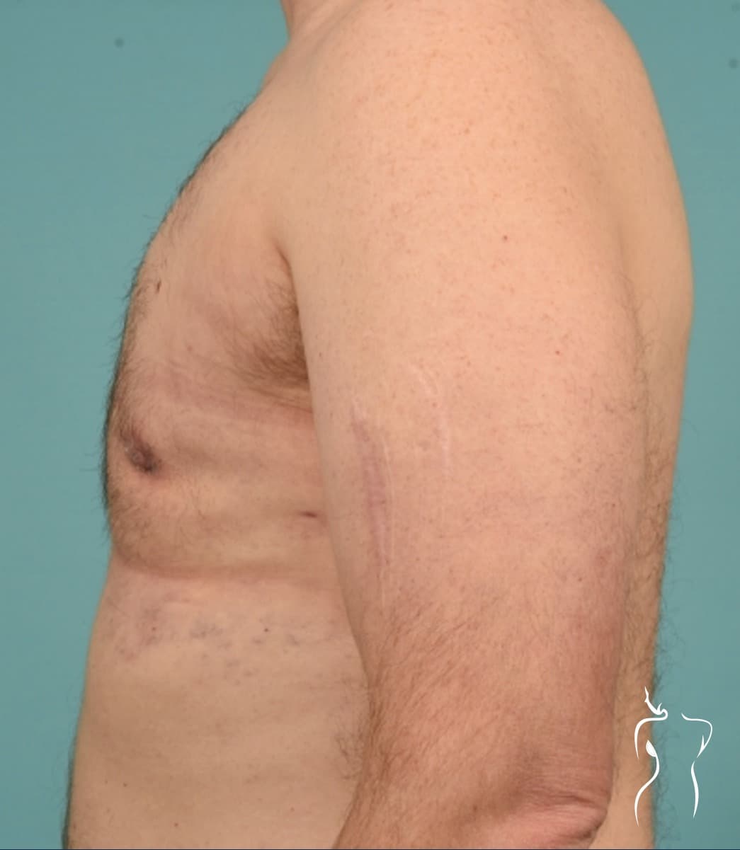 Gynecomastia, after — actual patient of Dr. Day