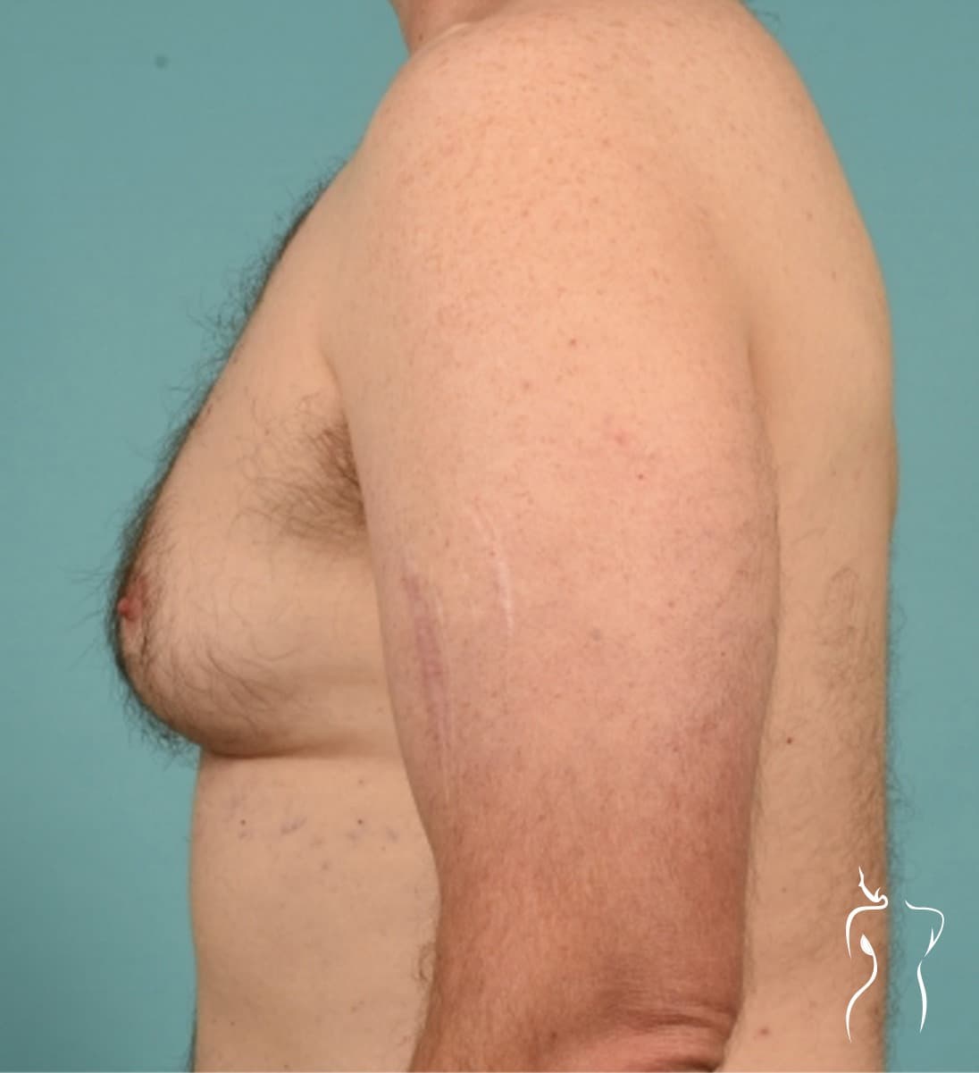 Gynecomastia, before — actual patient of Dr. Day