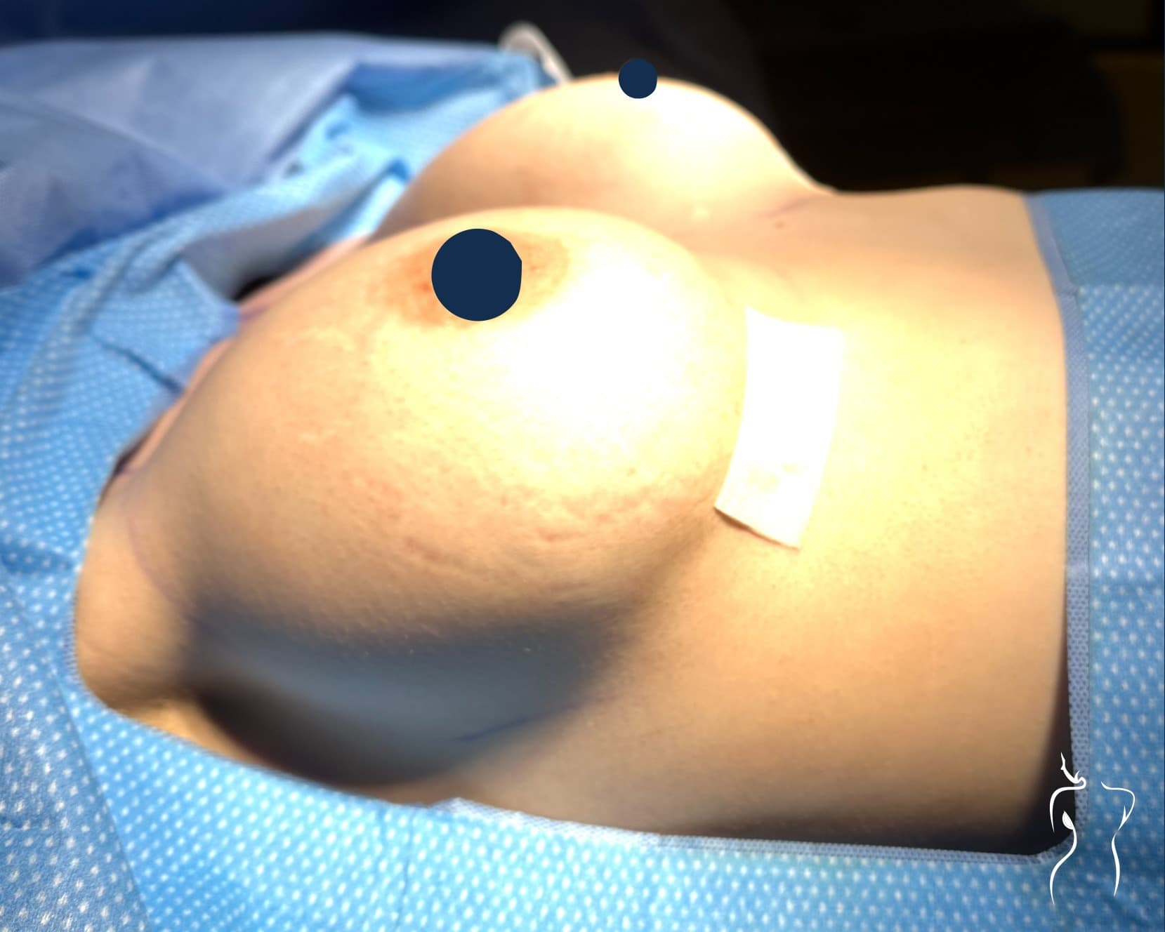 Implant Revision, after — actual patient of Dr. Day