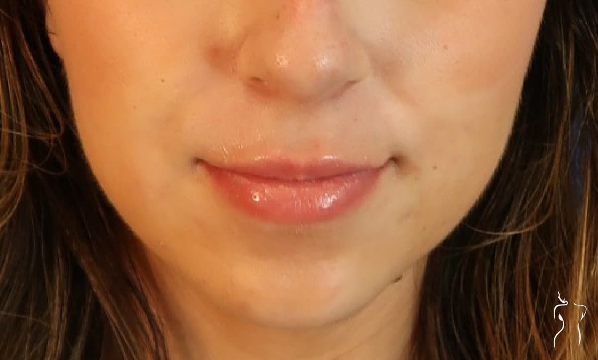 Dermal Fillers, after — actual patient of Dr. Day