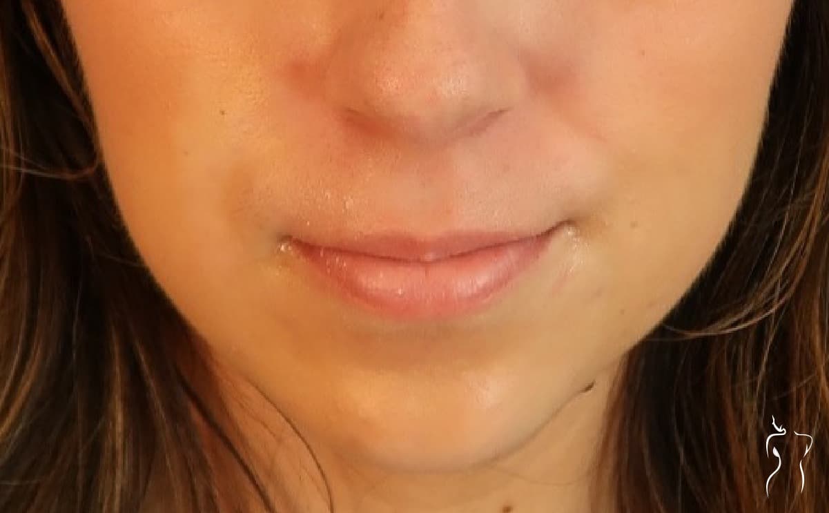 Dermal Fillers, before — actual patient of Dr. Day