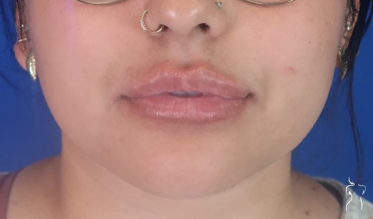 Dermal Fillers, after — actual patient of Dr. Day