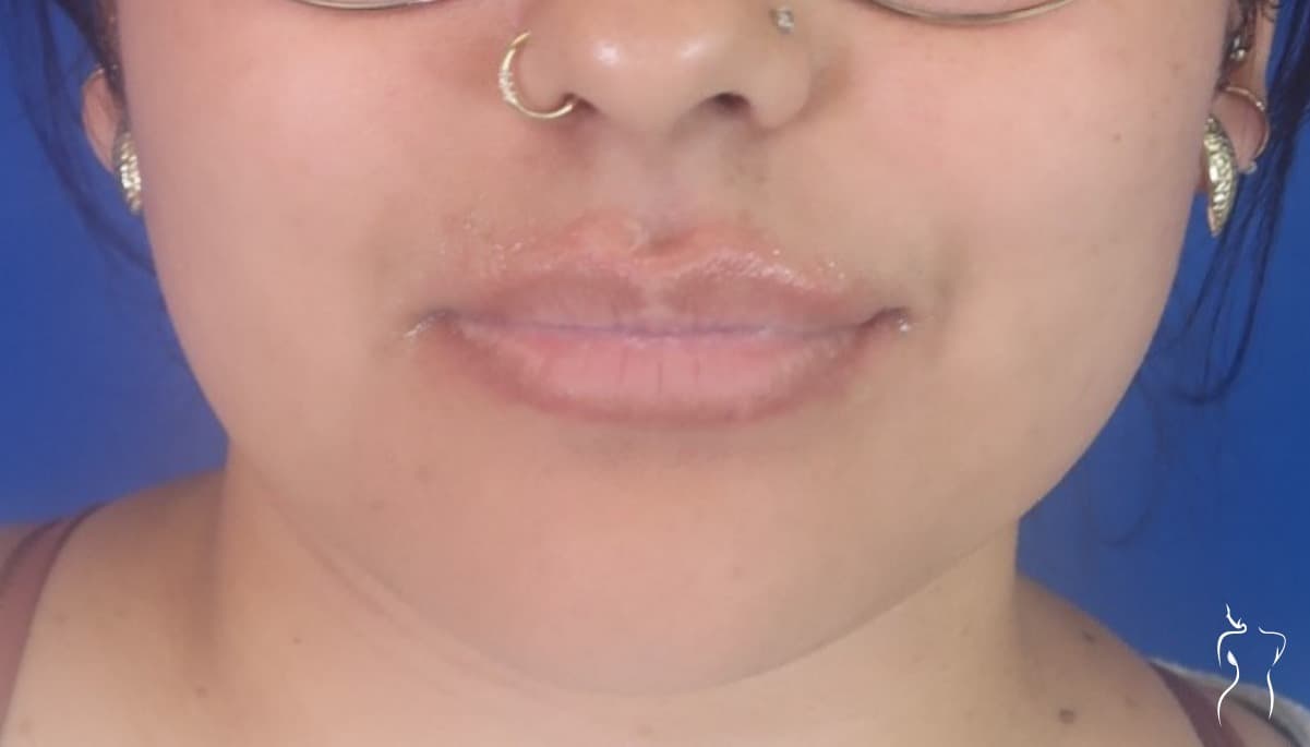 Dermal Fillers, before — actual patient of Dr. Day