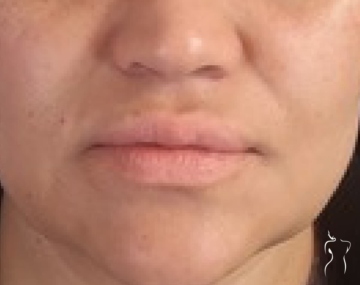 Dermal Fillers, after — actual patient of Dr. Day
