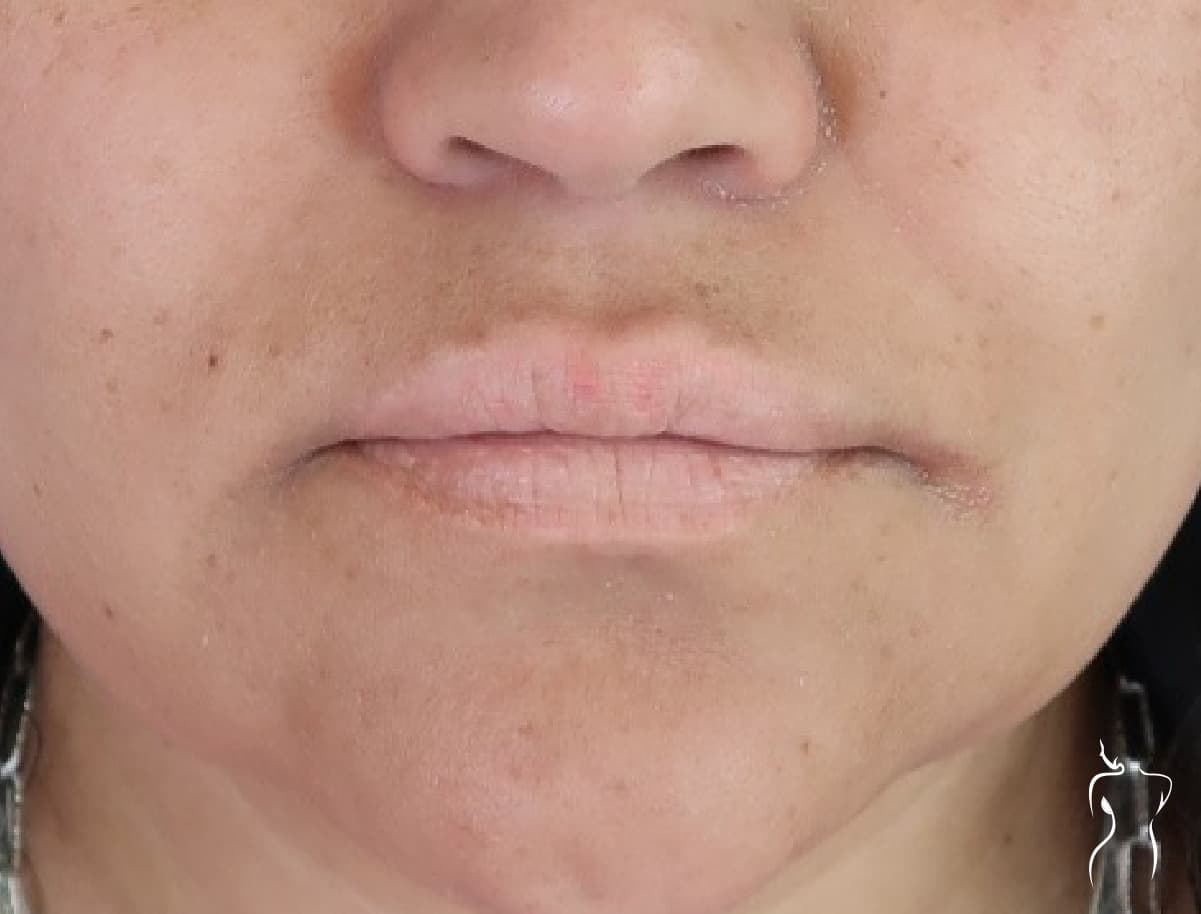 Dermal Fillers, before — actual patient of Dr. Day