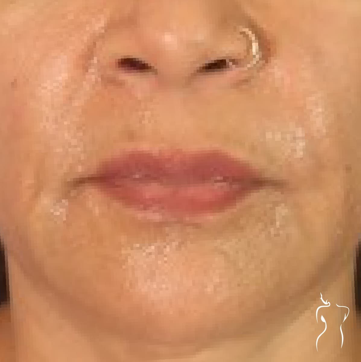 Dermal Fillers, after — actual patient of Dr. Day