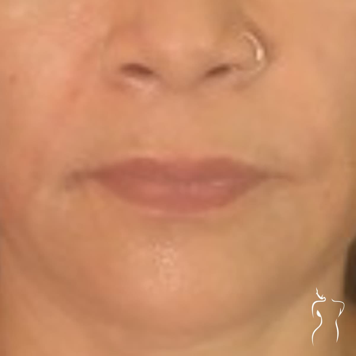 Dermal Fillers, before — actual patient of Dr. Day