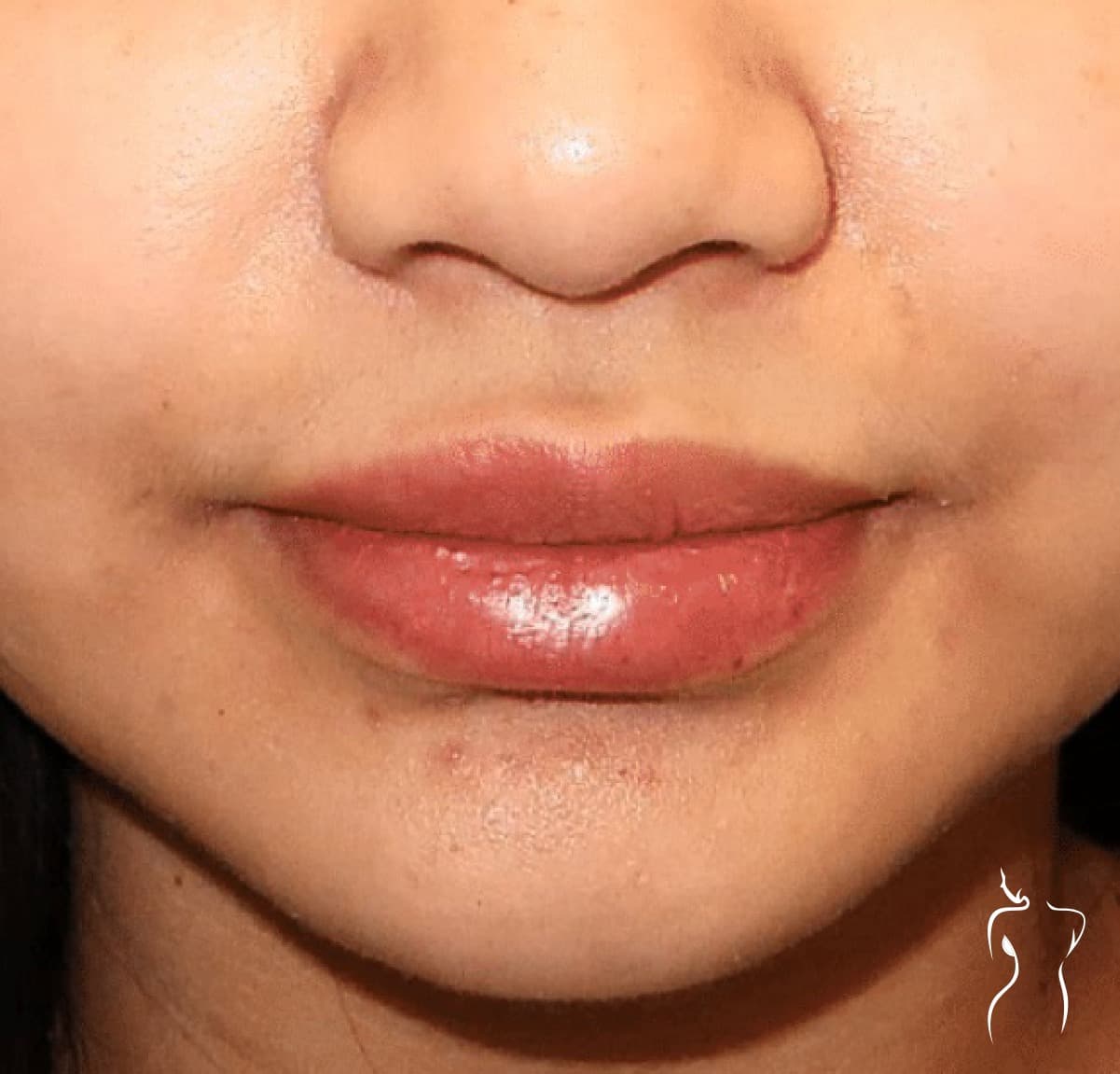 Dermal Fillers, after — actual patient of Dr. Day