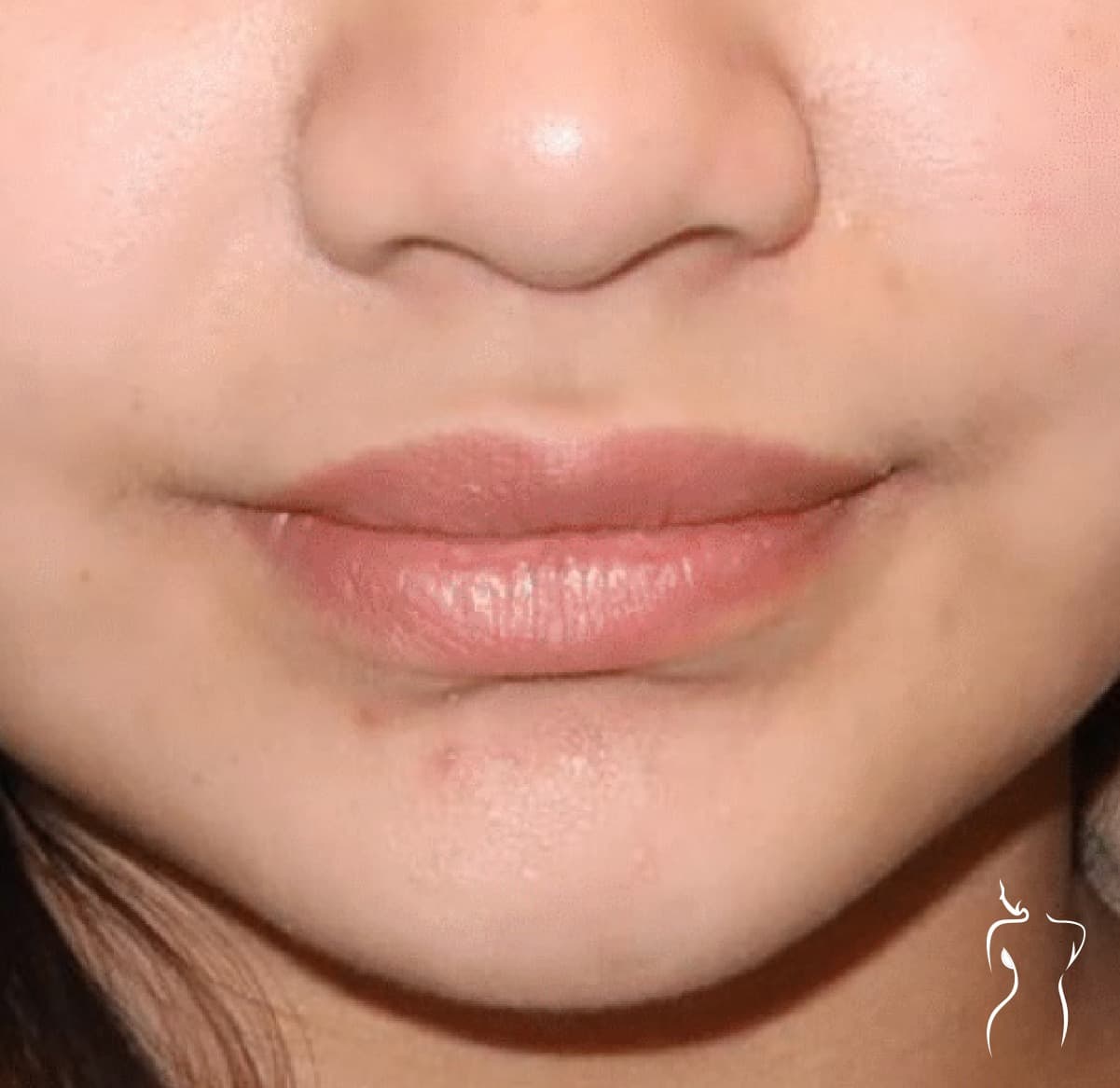 Dermal Fillers, before — actual patient of Dr. Day