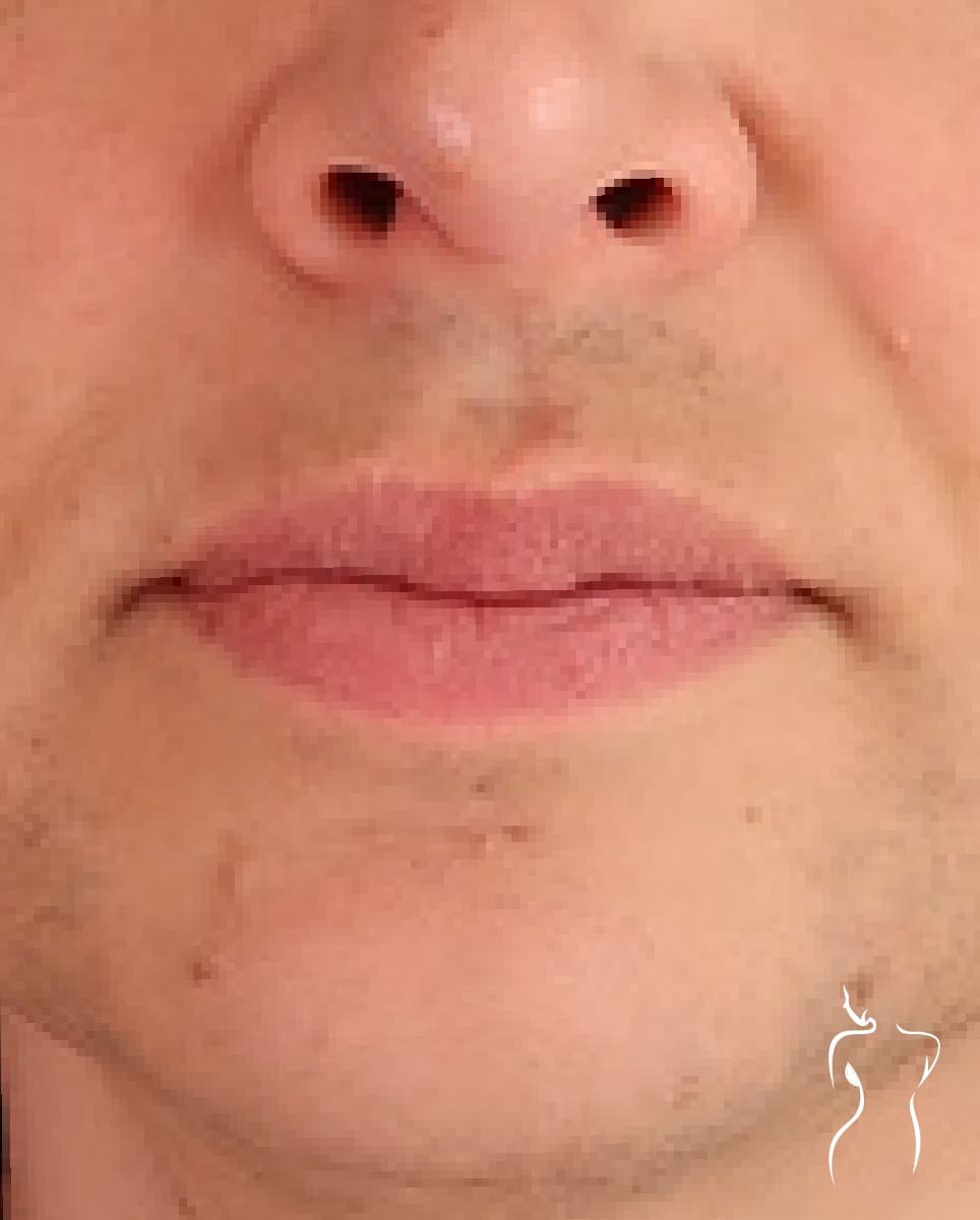 Lip Lift, after — actual patient of Dr. Day