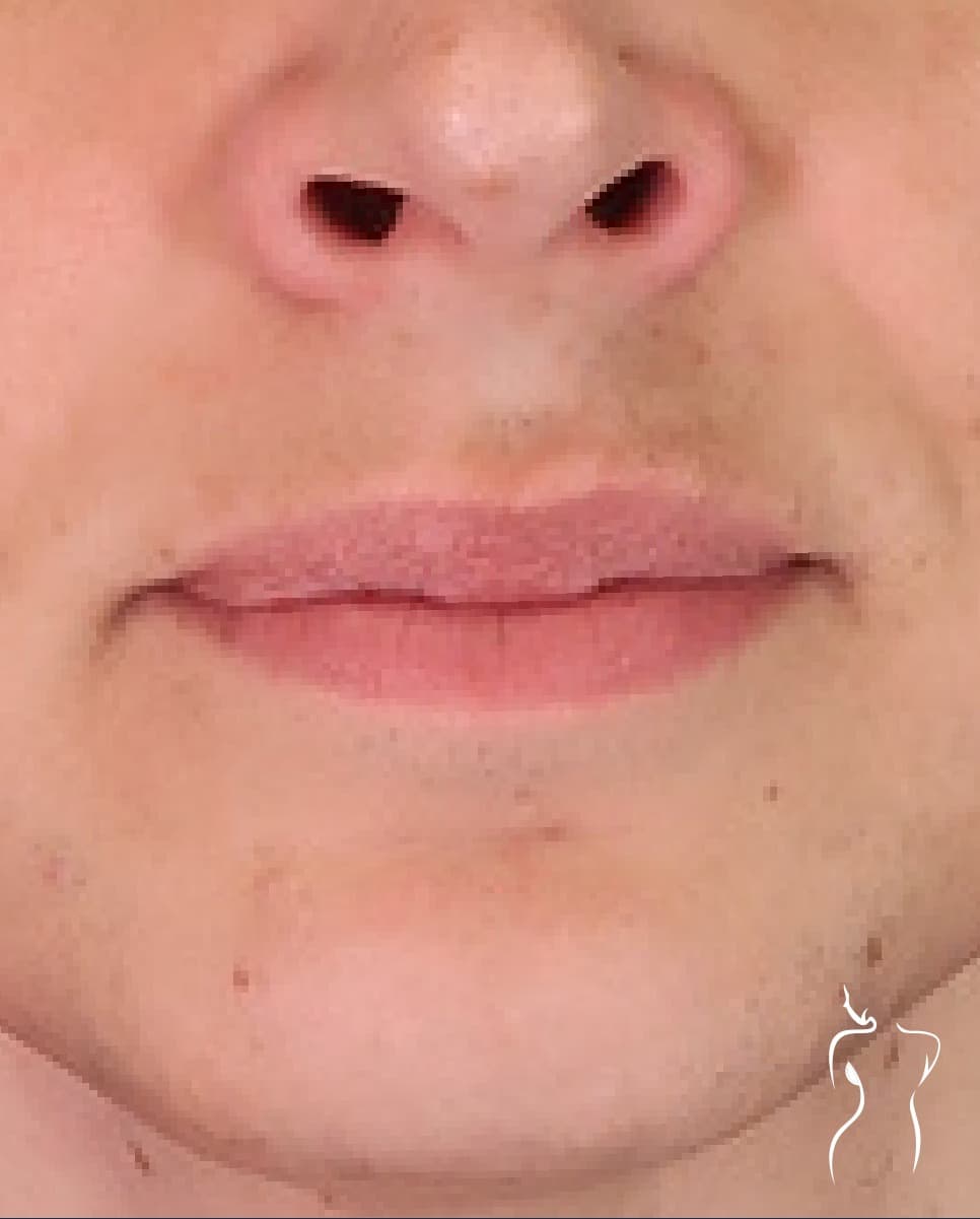 Lip Lift, before — actual patient of Dr. Day