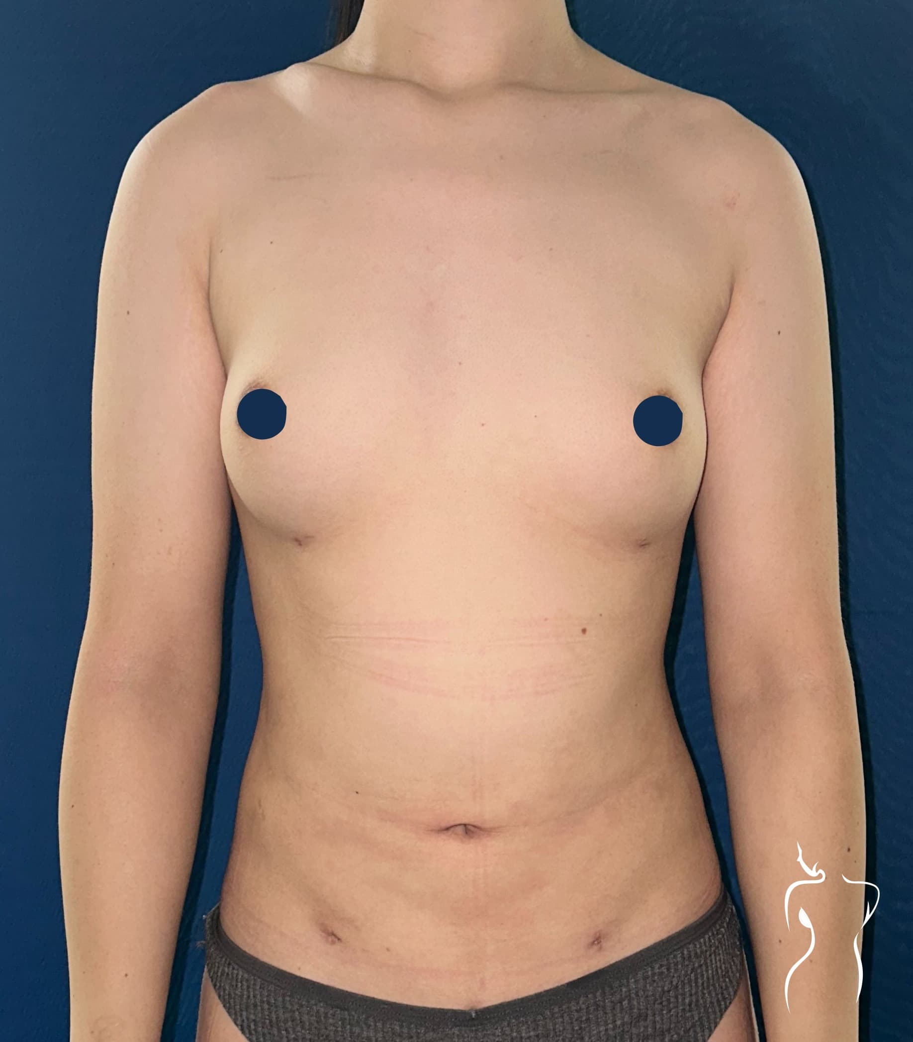 Liposuction, after — actual patient of Dr. Day