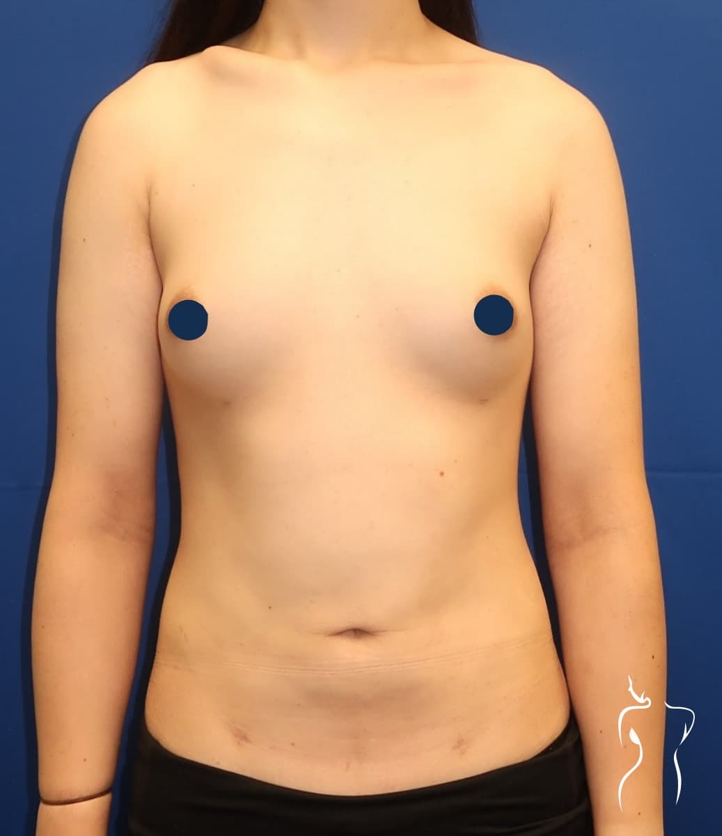 Liposuction, before — actual patient of Dr. Day