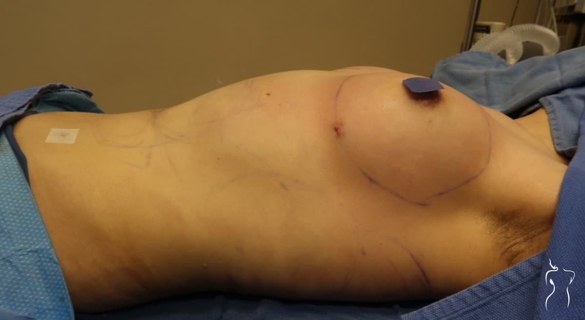 Liposuction, after — actual patient of Dr. Day